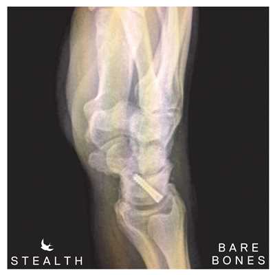 アルバム/Bare Bones/Stealth
